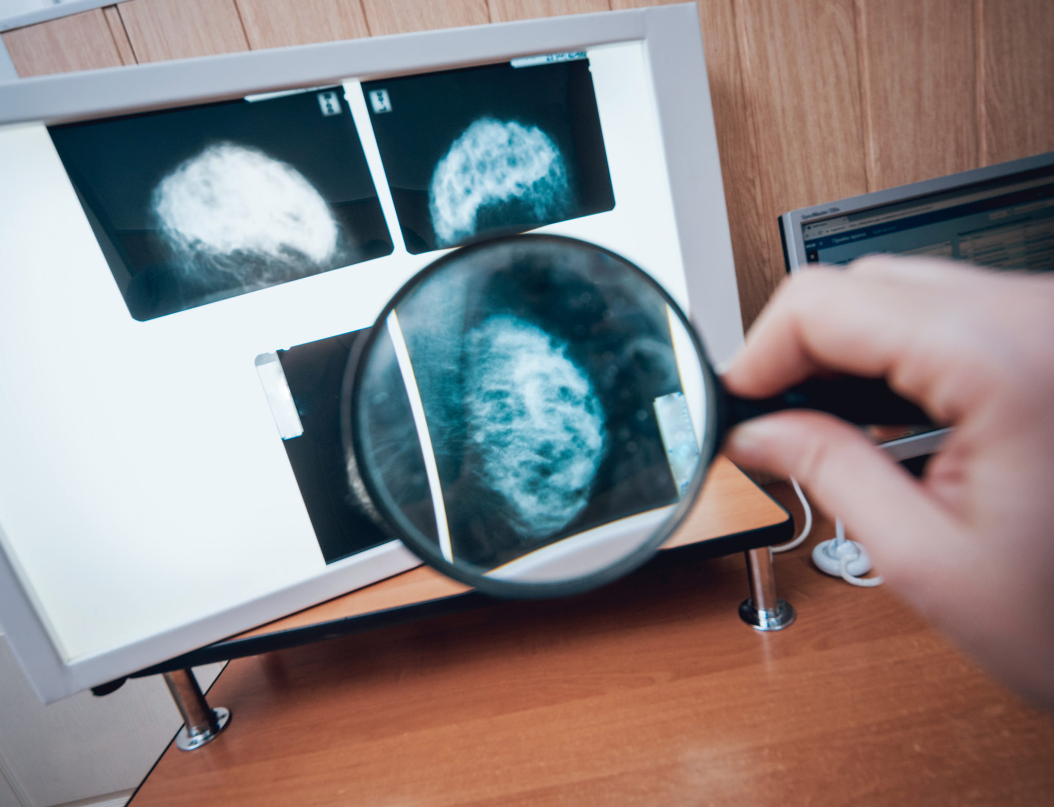 Doctor Examine Mammography Test. Medical Equipment At The Hospital