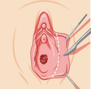 Labioplastia