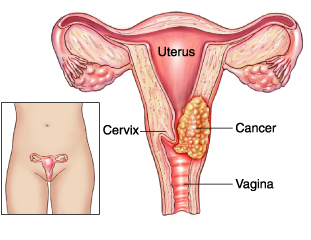 Cómo prevenir el cáncer de endometrio