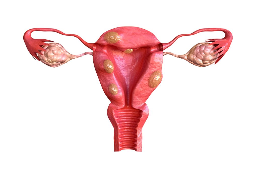 fibromas uterinos