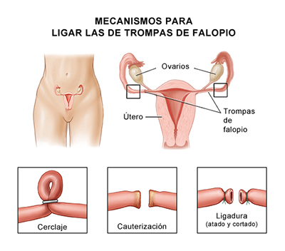 calificación película Cha Ligadura de trompas: un anticonceptivo permanente - Clínica Pedrosa